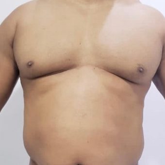 Liposuction and Ab etching 1