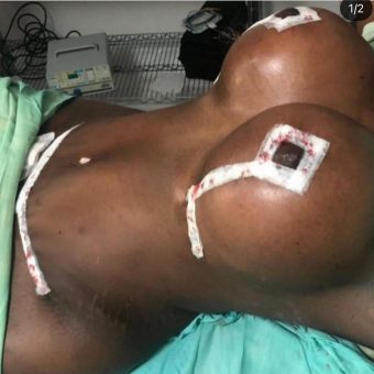 Mommy make over with breast lift and augmentation 2