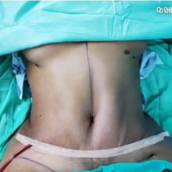 Tummy tuck, Liposculpture with hip transfer and Brazilian buttlift 2