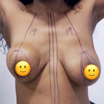 breast uplift and breast augmentation