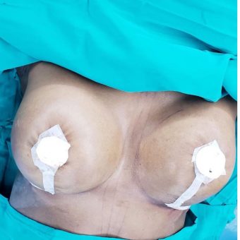 breast uplift and breast augmentation2